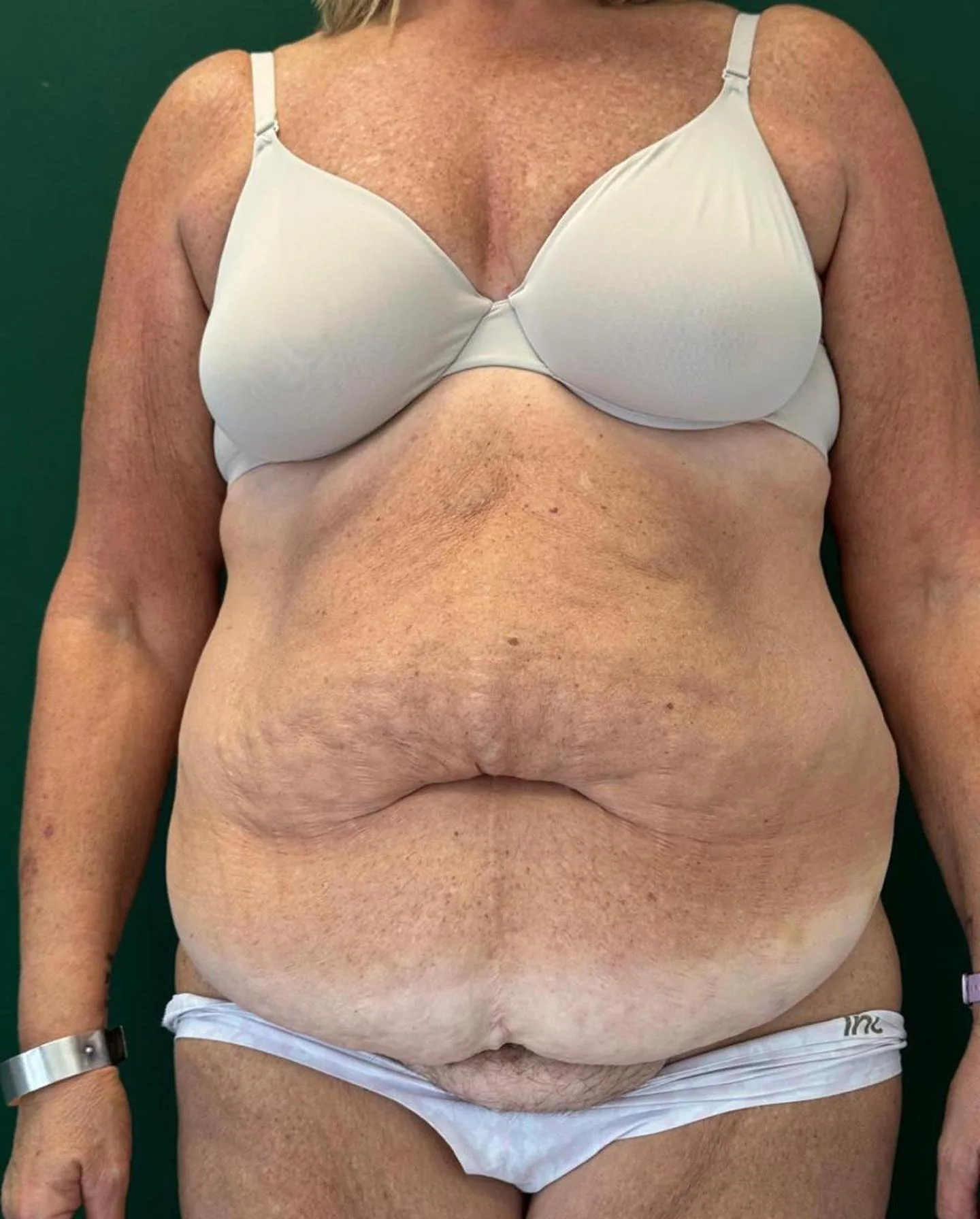 Abdominoplasty Before